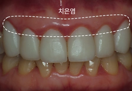 01. 불량 보철물로 인한 만성 치은염과 구취가 심한 상태